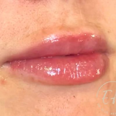 after lip