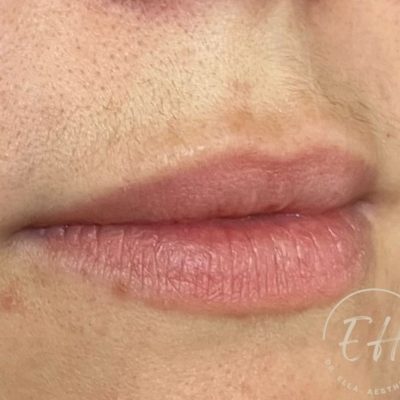 before lip