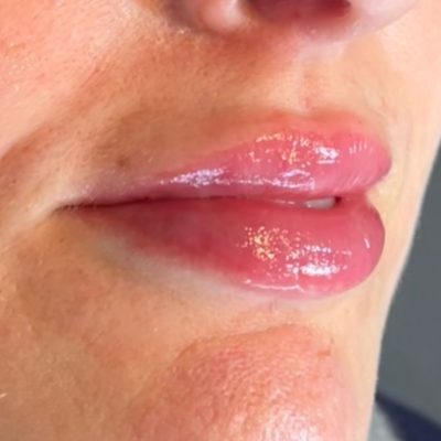 lip after