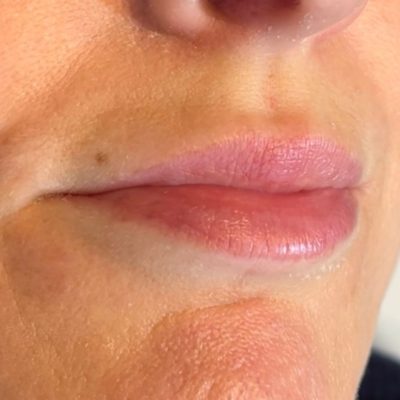 lip before
