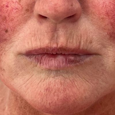 lip old